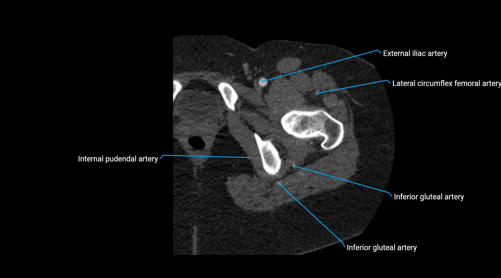 CTA lower limb cross sectional anatomy labelled image _62.webp